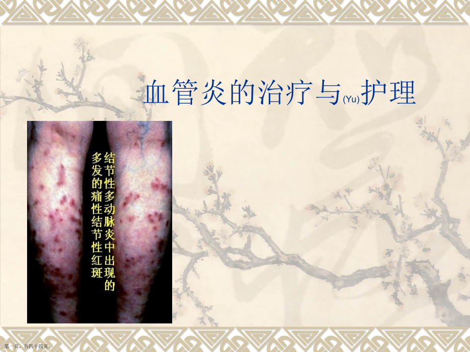 血管炎患者的护理个案培训.pptx_第1页