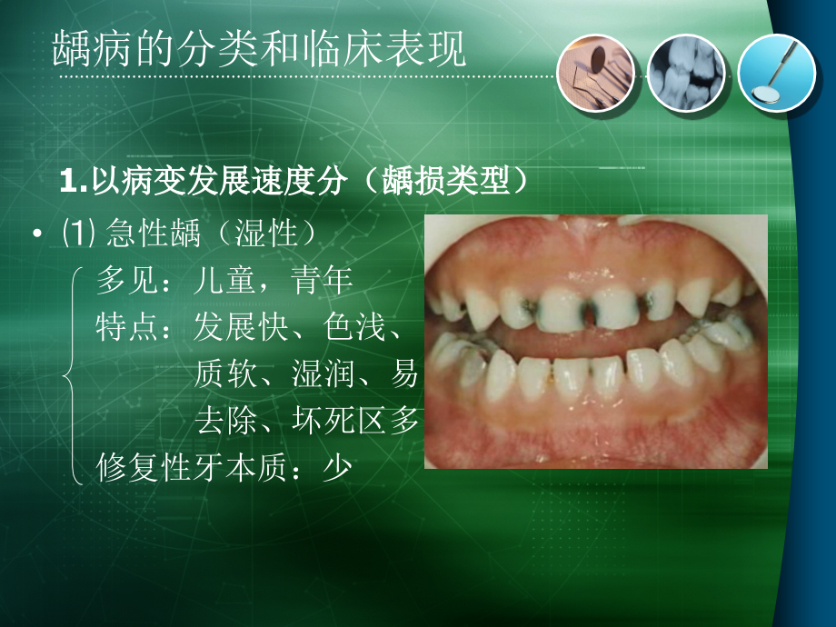 龋病的分类和临床表现.ppt_第2页