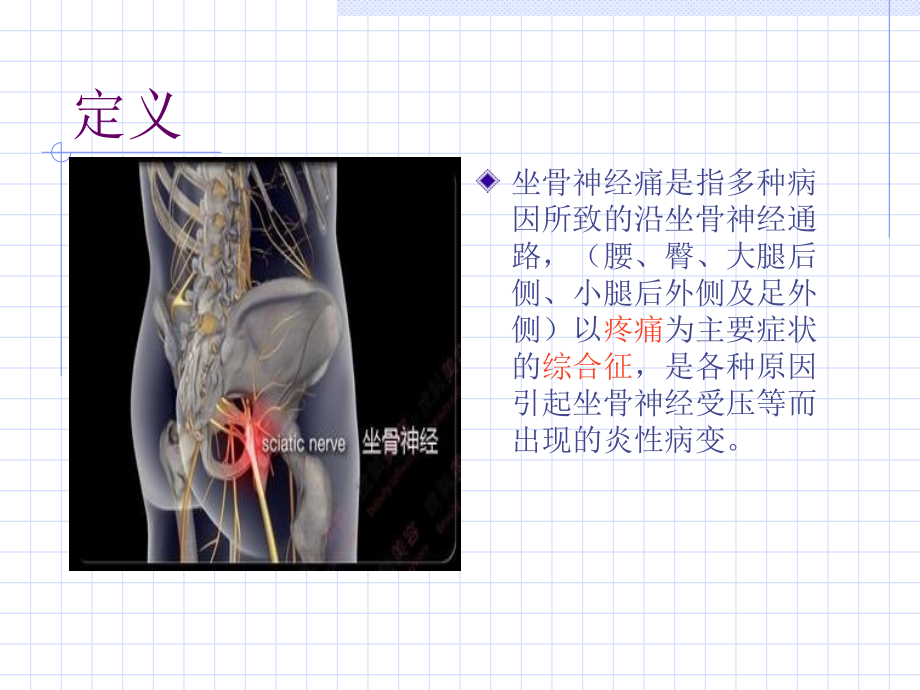 坐骨神经痛课件.ppt_第2页