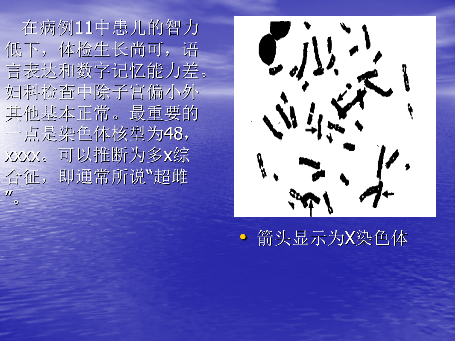 多X综合征.ppt_第2页