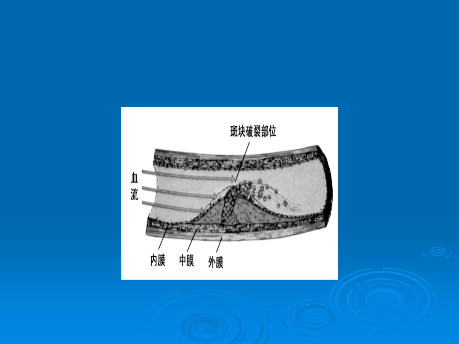 急性冠脉综.ppt_第2页