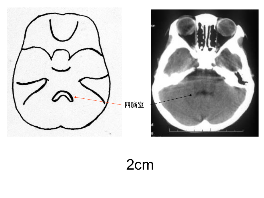 头颅CT影像解剖.ppt_第2页
