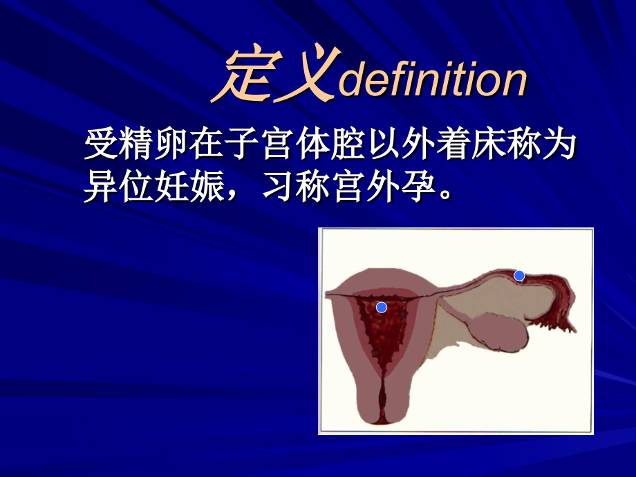 异位妊娠课件.ppt_第1页
