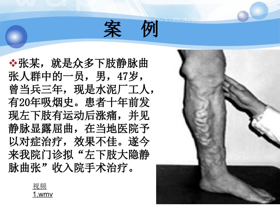 下肢静脉曲张幻灯片.ppt_第1页