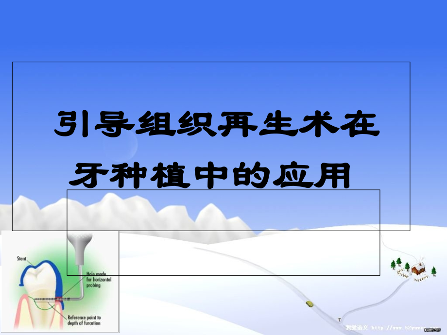 引导组织再生术的研究进展.ppt_第1页