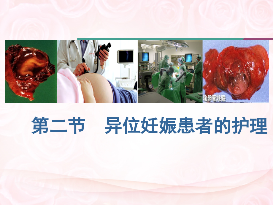 异位妊娠的相关护理.ppt_第1页