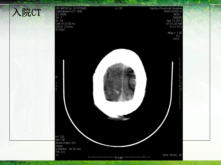 放射科-静脉窦血栓的病例汇报及总结.ppt_第2页