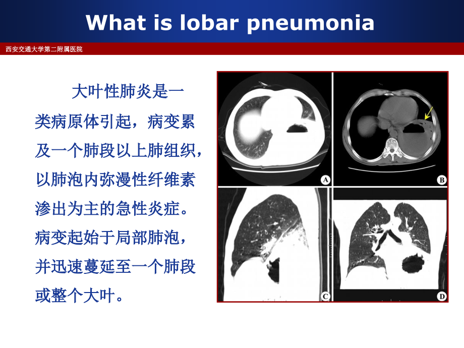 小儿大叶性肺炎病原谱特点及抗生素选择.ppt_第2页