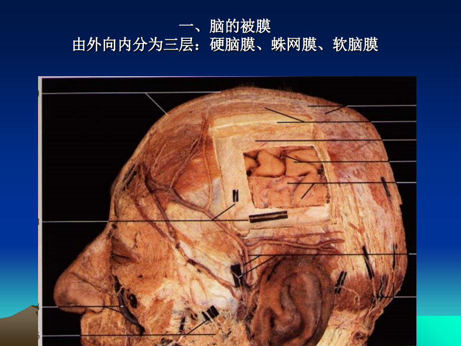 录-断层3(脑膜脑血管).ppt_第1页
