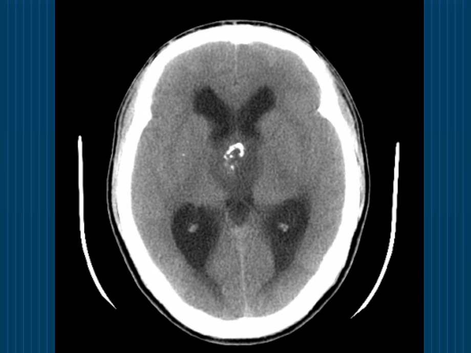 怎么看头颅CT和MRI.ppt_第2页
