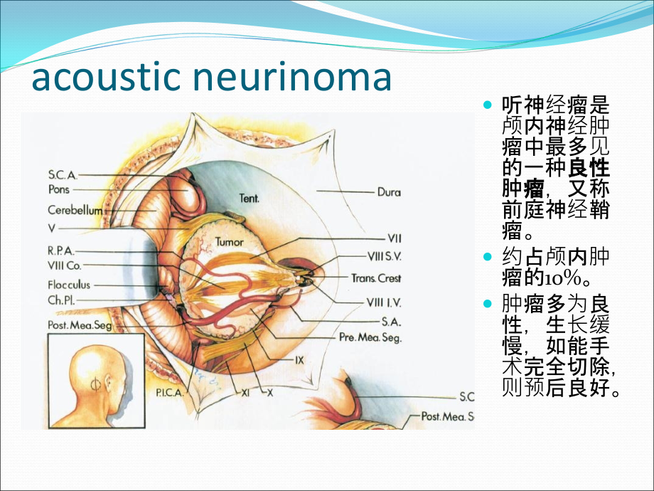 听神经瘤围手术期护理.ppt_第1页