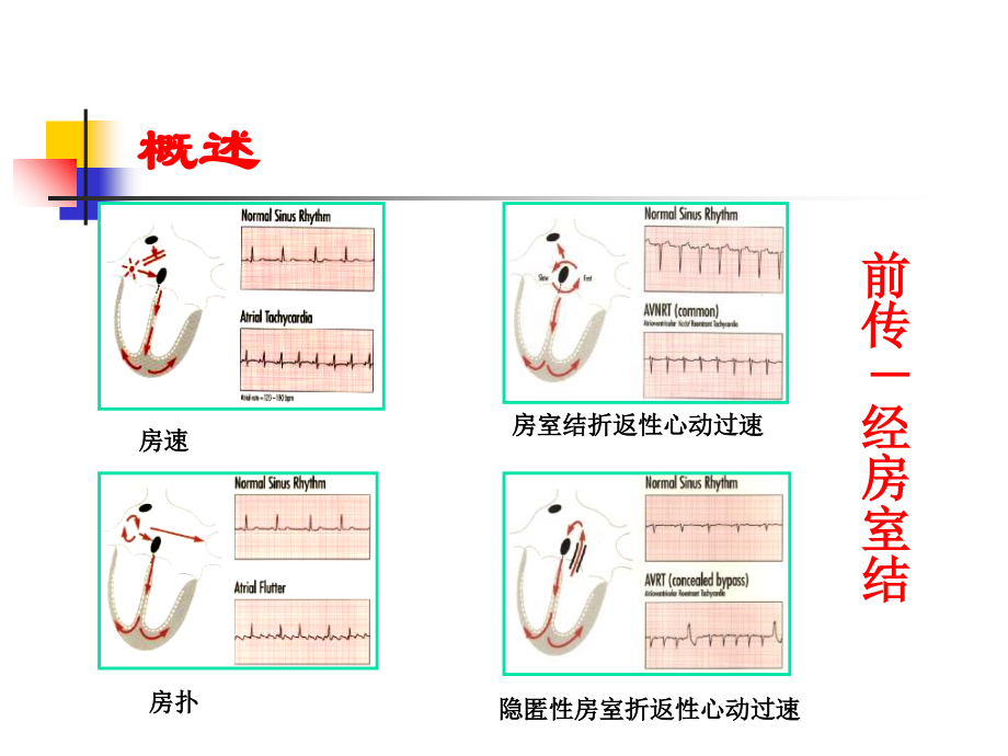 窄QRS波心动过速概述、分类和鉴别诊断.ppt_第2页