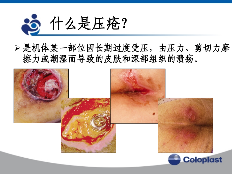 压疮的预防及治疗.ppt_第1页