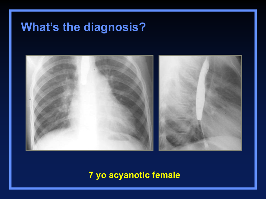 Left-to-right-shunts.ppt_第1页