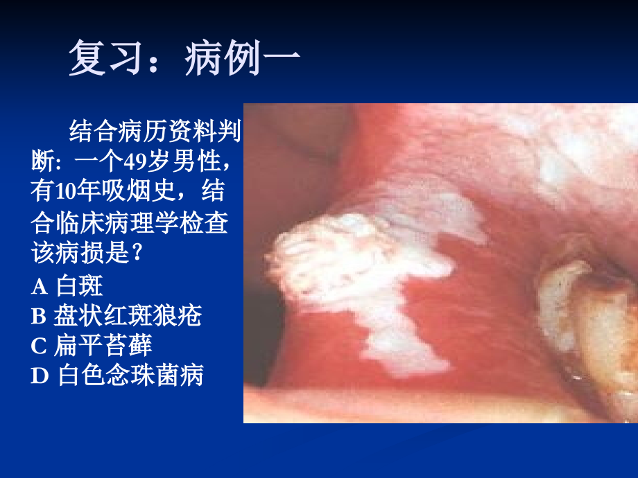 新口腔粘膜病.ppt_第2页