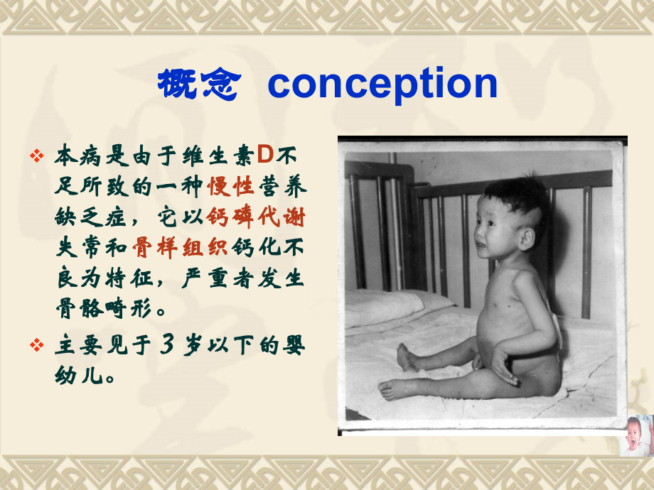 维生素D缺乏性佝偻病(1).ppt_第2页