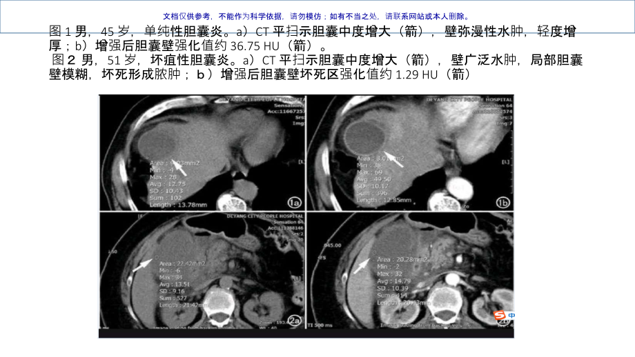 胆囊炎和坏疽性胆囊炎的CT诊疗和鉴别诊疗课件.ppt_第2页