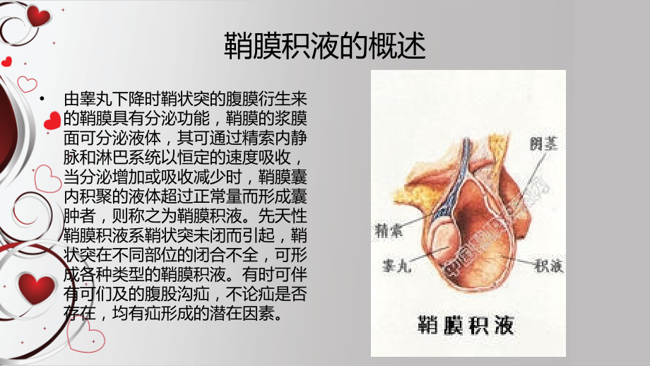 医学课件鞘膜积液的护理.ppt_第1页