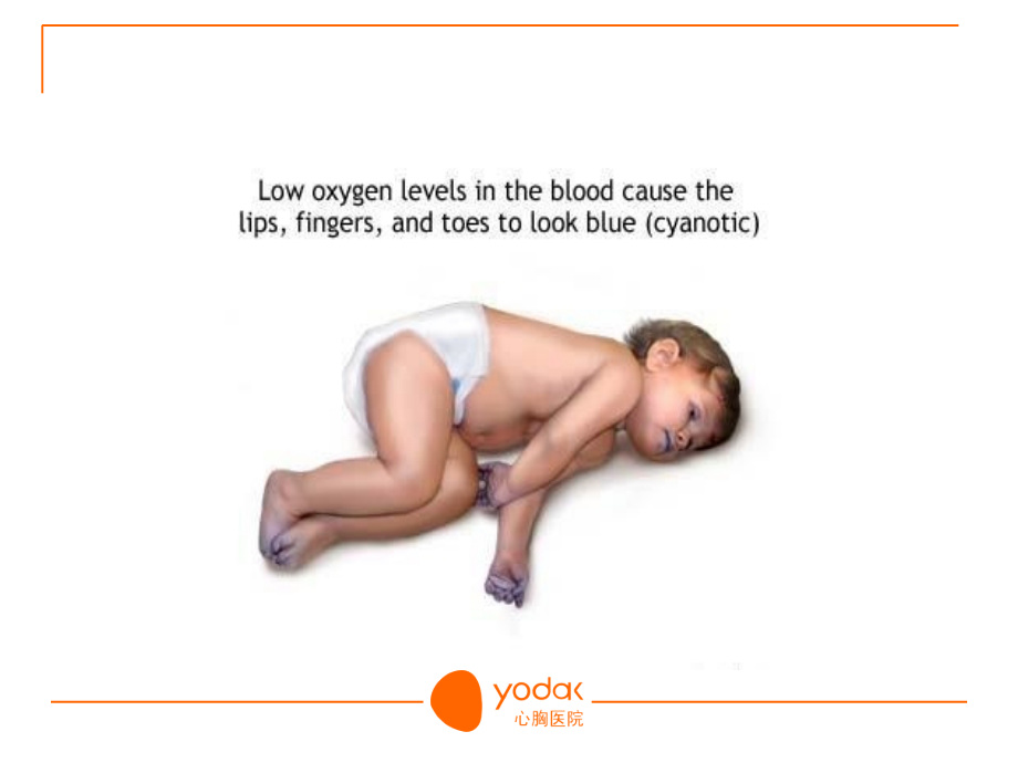 格林手术治疗复杂先心病.ppt_第2页