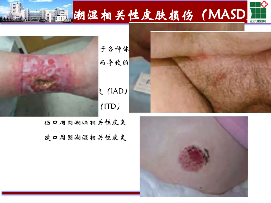 医学课件失禁性皮炎专业医学知识宣讲.ppt_第2页