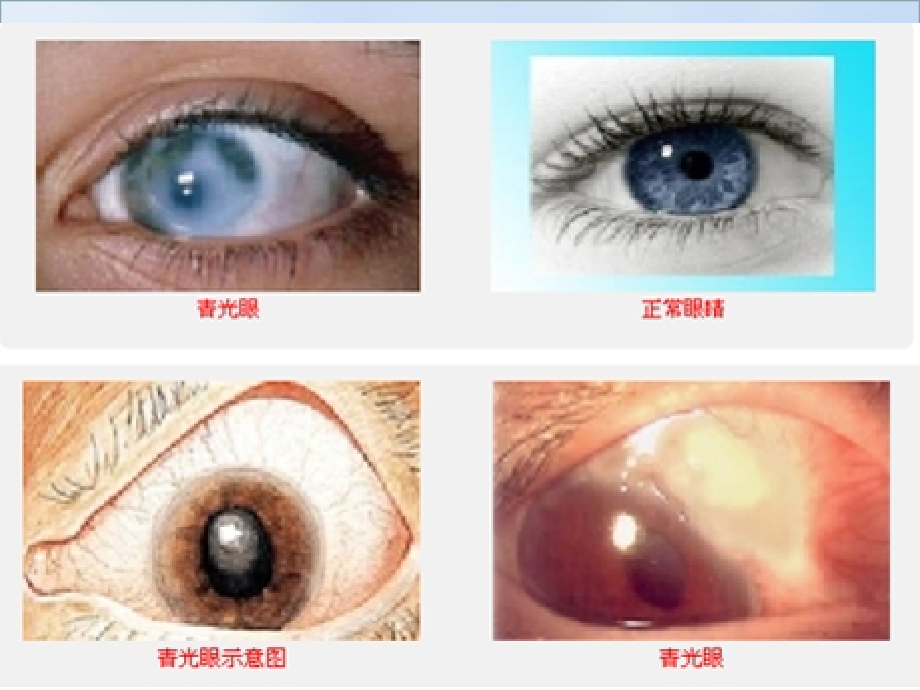 眼科青光眼医学知识培训课件.ppt_第1页