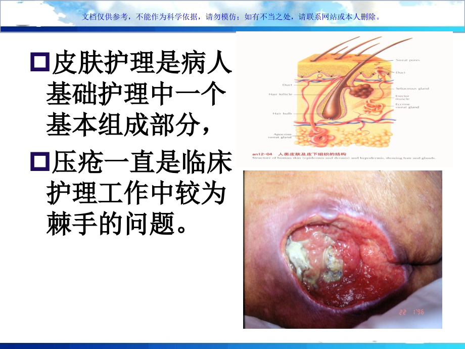 压疮新分期和医疗护理课件.ppt_第2页