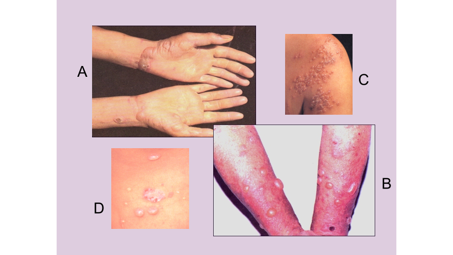 医学课件大疱性皮肤病诊治.ppt_第1页