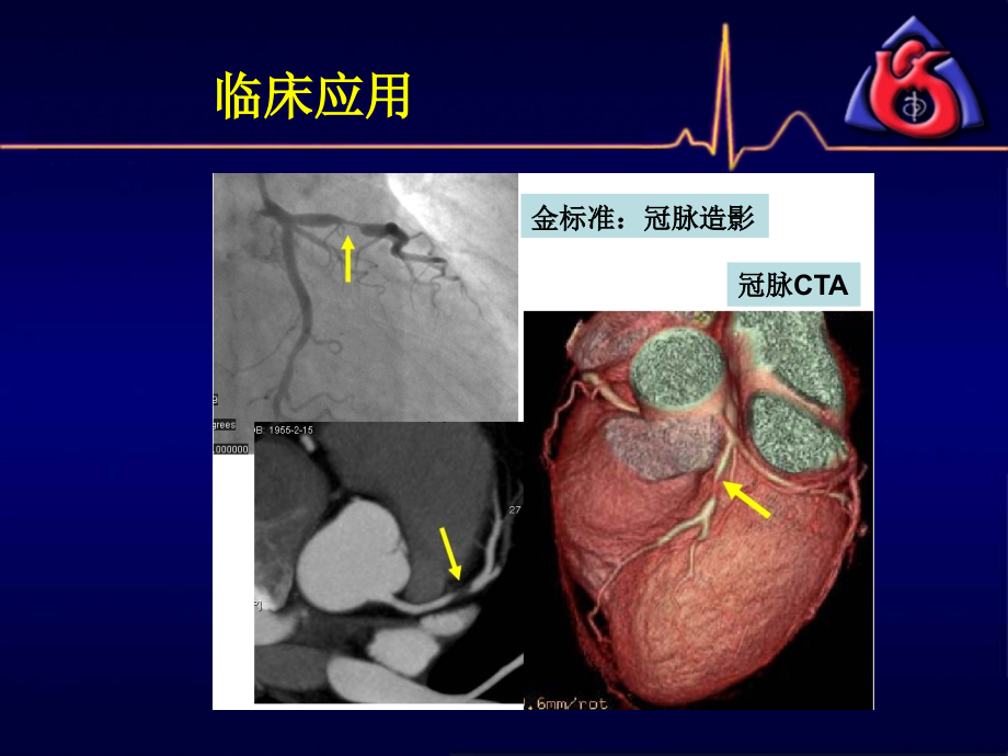医学冠脉CTA读片非常经典.ppt_第2页