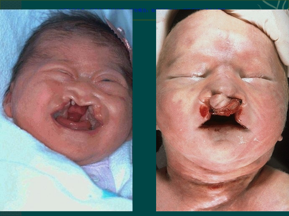 医学遗传学多基因遗传病课件.ppt_第2页