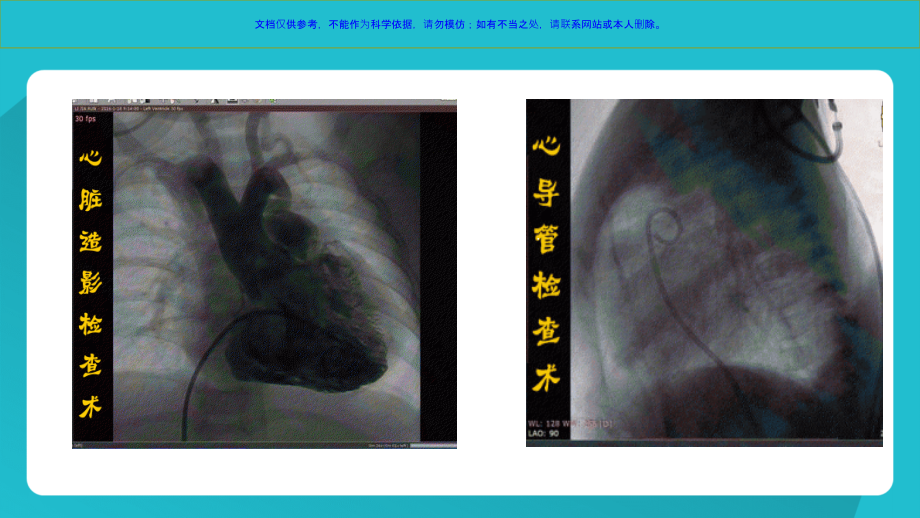心导管检查术专题宣讲课件.ppt_第2页