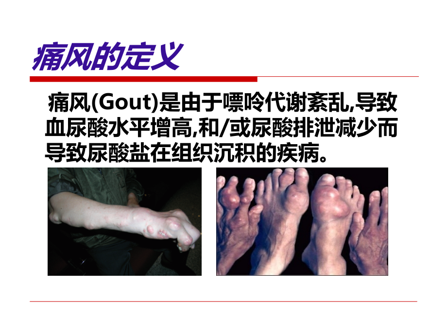 医学课件痛风的诊治专业医学知识宣讲.ppt_第1页