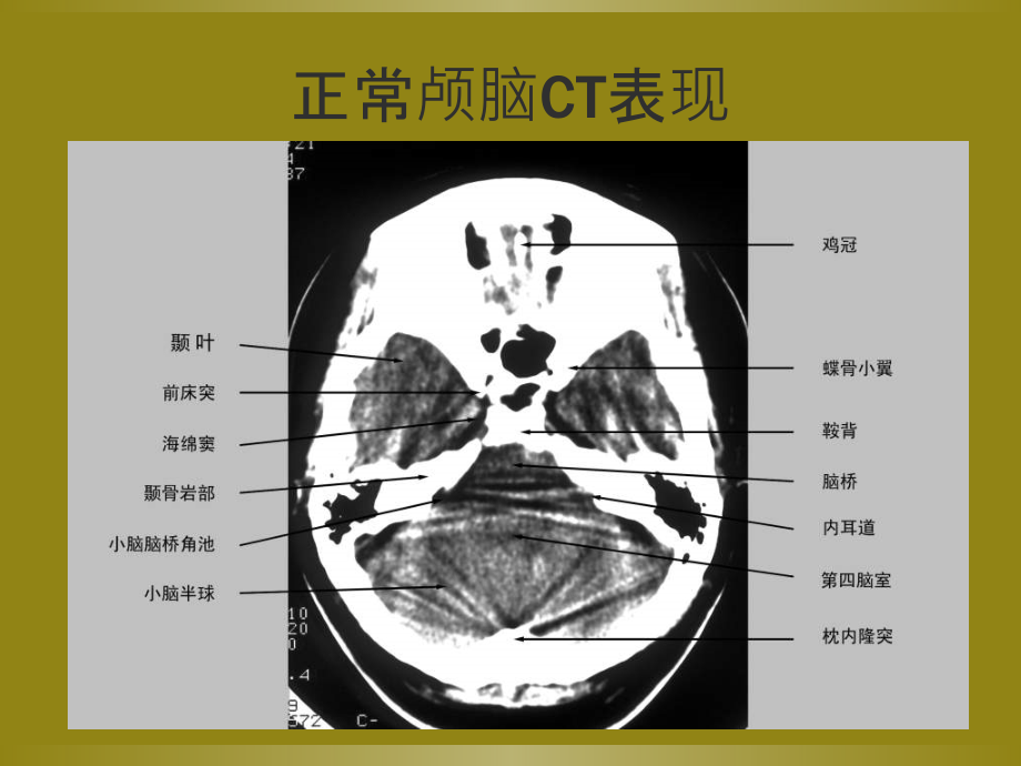 医学课件颅内钙化专业医学知识宣讲.ppt_第1页