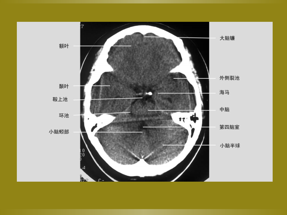 医学课件颅内钙化专业医学知识宣讲.ppt_第2页