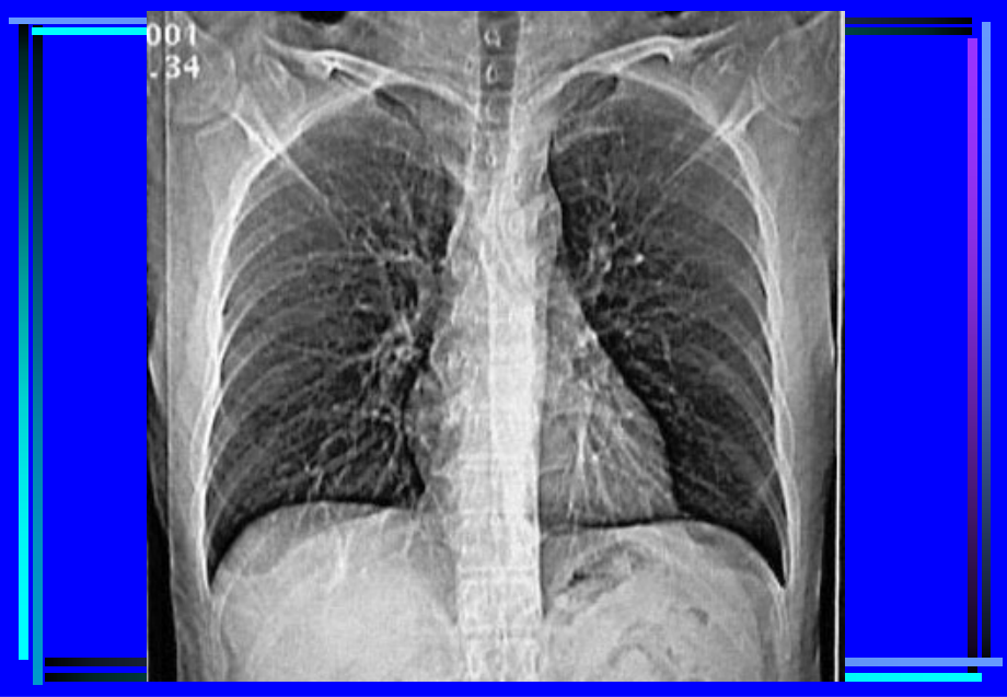 医学胸部CT诊疗大量实例CT片.ppt_第2页