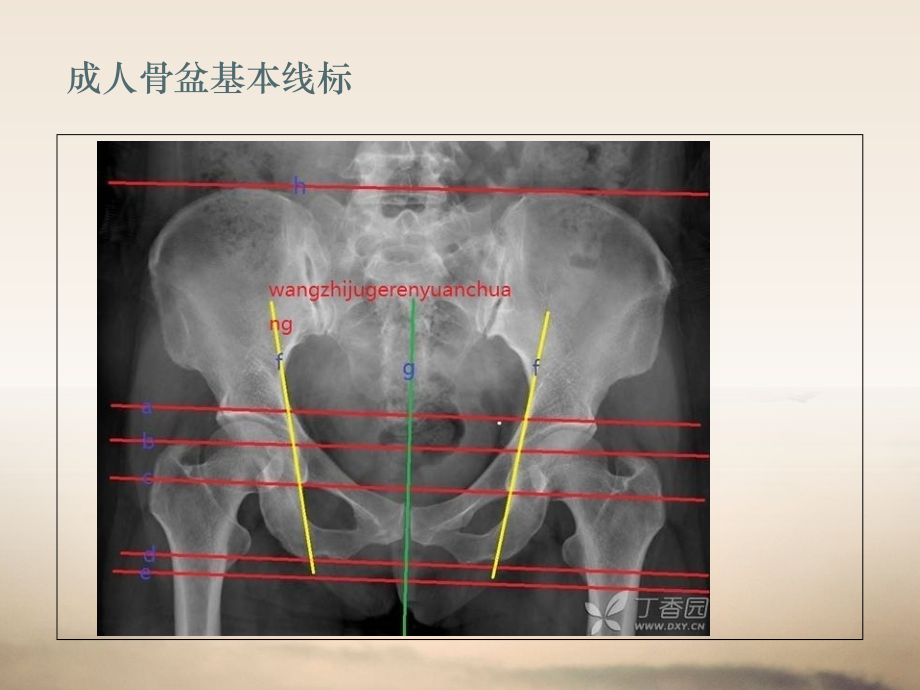 医学课件髋关节X测量.ppt_第1页