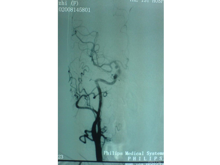 医学课件后交通动脉瘤自制.ppt_第2页
