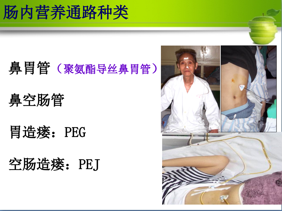 医学课件留置胃管的医疗护理.ppt_第1页