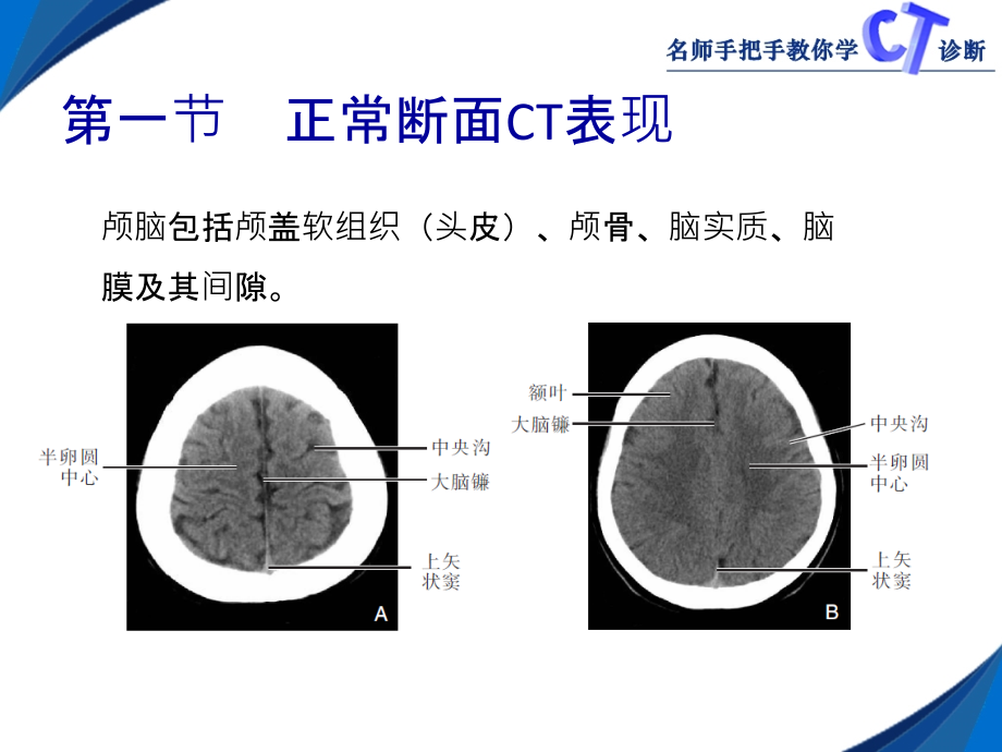医学颅脑CT影像学表现.ppt_第2页