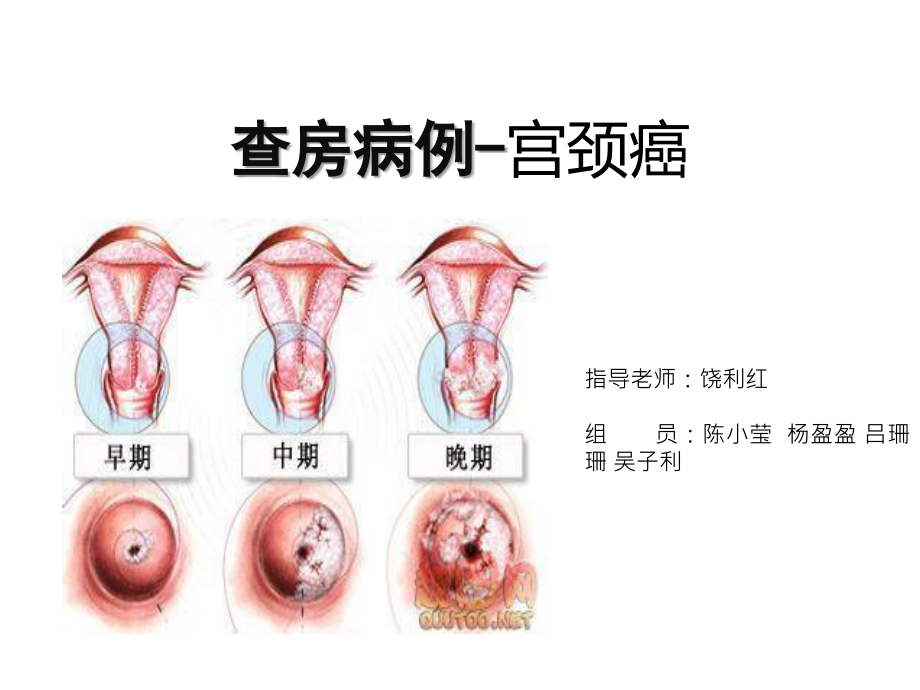 医学宫颈癌护理查房专题.ppt_第2页