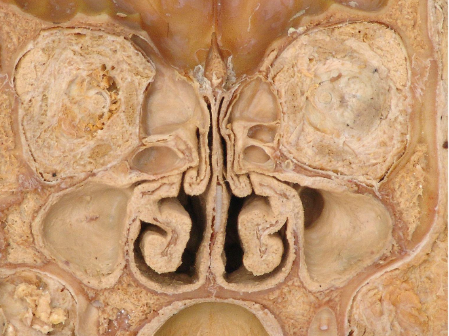 医学副鼻窦解剖学基础.ppt_第2页