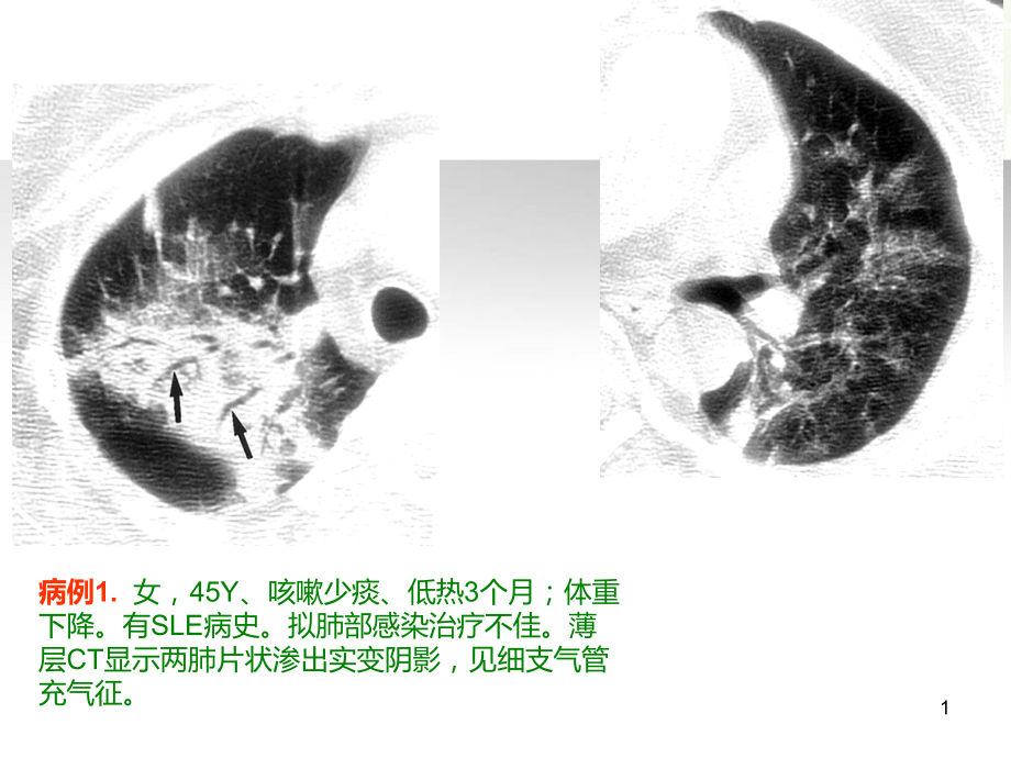 医学课件隐源性机化性肺炎的诊断进展刘.ppt_第1页