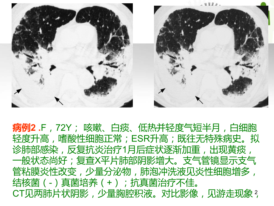 医学课件隐源性机化性肺炎的诊断进展刘.ppt_第2页