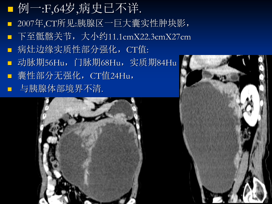 医学胰腺囊性和囊实性病变.ppt_第2页