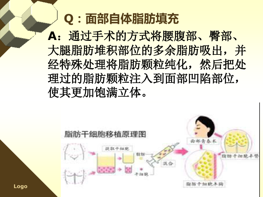医学课件面部自体脂肪填充.ppt_第2页