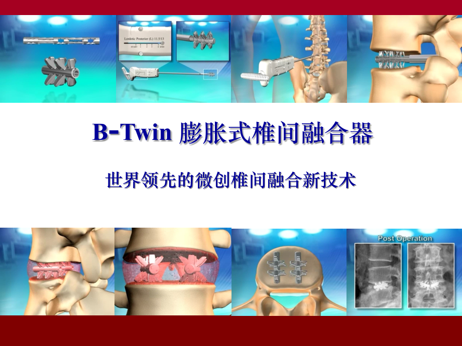 BTwin膨胀式腰椎融合器.ppt_第2页