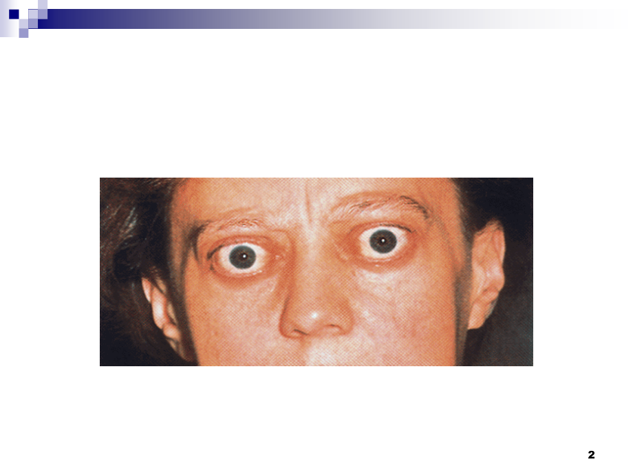医学课件甲状腺功能亢进危象.ppt_第2页