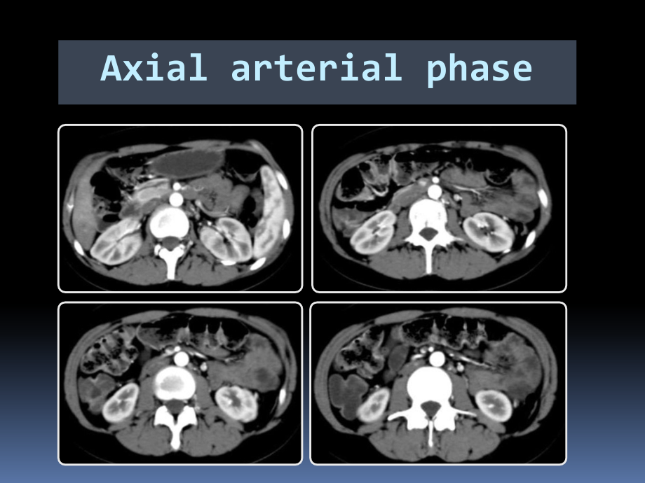 小肠疾病影像学诊断(医学PPT课件).pptx_第2页