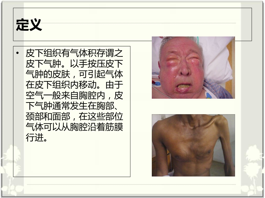 医学皮下气肿宣教.ppt_第2页
