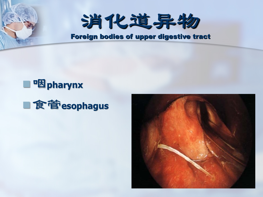 医学课件消化道异物专业医学知识宣讲.ppt_第2页