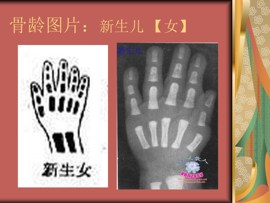 医学女性骨龄X线图片对照.ppt_第2页